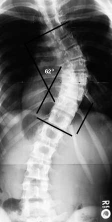 Hình ảnh X-quang vẹo cột sống thắt lưng
